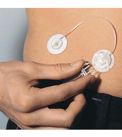 Sure-T 6 mm/80 cm mit Luer-Anschluss 10 Stück